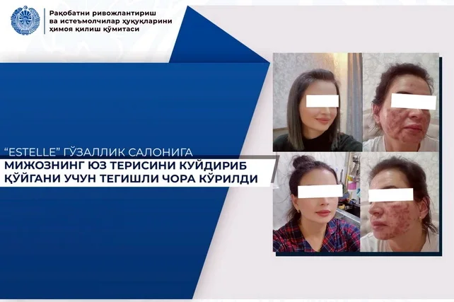 Beauty salon Estelle in Tashkent accused of causing severe chemical burn to client