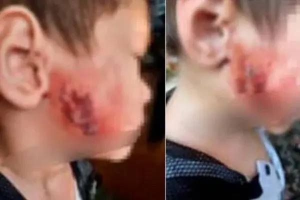 A three-year-old child was burned in the face in the capital’s kindergarten,